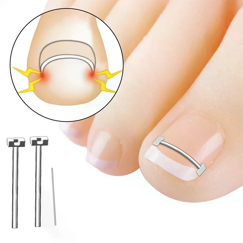 Ingrown Toenail Corrector Tools Pedicure Recover Embed Toe Nail Treatment Professional Ingrown Toenail Correction Foot Care Tool