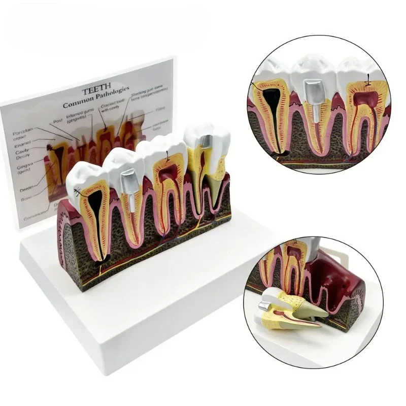 

Dental Pathologies Anatomical Structure Medical Model For Teaching Studying Root Canal Treatment Demonstration Dentist Teeth