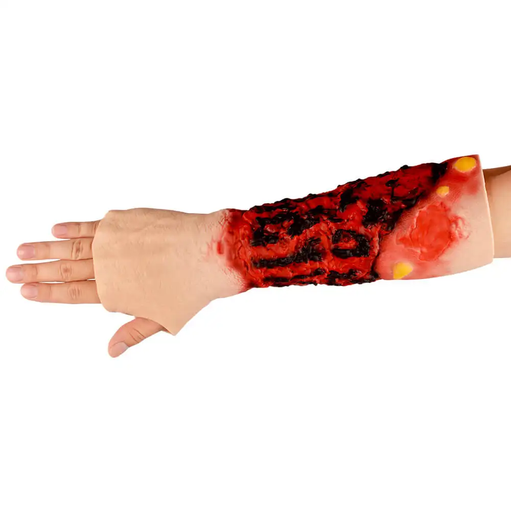 Ultrassist Forearm Burn Simulation Sleeve 3rd Degree Burn Wound Care Training Silicone Wearable for Medical Teaching Education