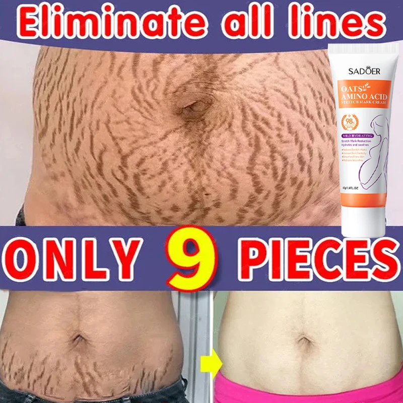 Stretch Marks Permanent Removal Cream Eliminate Body Belly Stretch Marks Swelling Marks Remove Skin Cracks Repair Firming Care