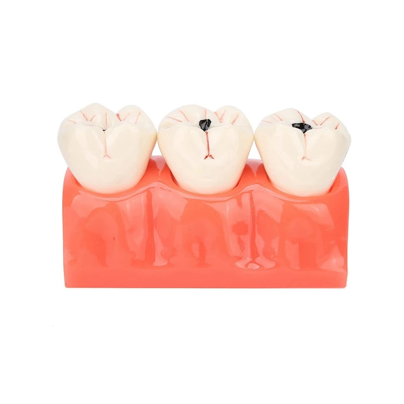 

Tooth Model Oral Teaching 4X Caries Decomposition Model Demonstration Model For Nurse Student