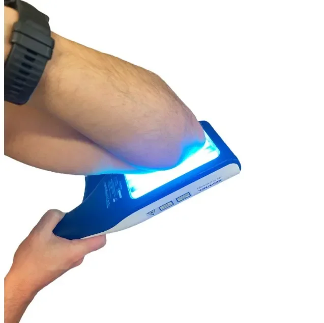 phototherapy device for atopic dermatitis psoriasis treatment Best Portable uvb 311nm narrow band handheld ultraviolet