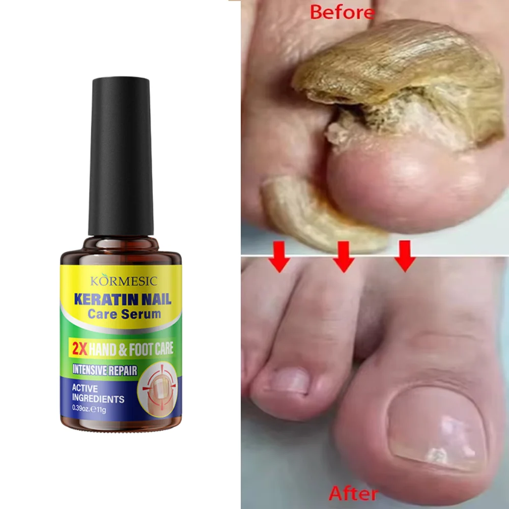 Nail Fungus Care Solution Anti-Infection Onychomycosis Repair Damaged Cracked Hand Foot Nail Manicureed Health Care Essence