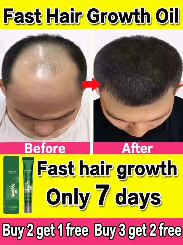 Produk penumbuh rambut, minyak penumbuh rambut cepat tumbuh efektif kebotakan esensial memperbaiki kemiringan Anti melahirkan