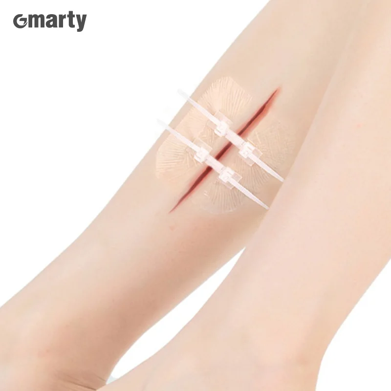 Emergency Wound Closure Zip Stitch Sutures Bandaids Repair Wounds Without Stitches For Outdoor Activities Quick Clot Wound