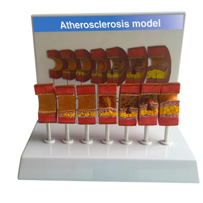 

Artery Anatomical Model Anatomical Vessel Atherosclerosis Thrombus Vascular Model Human Artery Anatomy Model