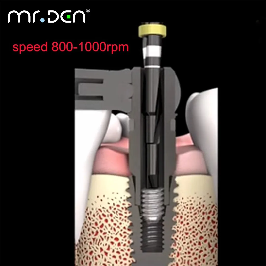 

MR DEN Dental Implant Failure Retrieval Kit Implant Abutment Screw Removal Tool Implant Failure Emergency Kit