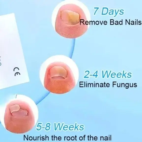 

Лазерный аппарат для лечения грибка ногтей - 905 нм инфракрасный + 470 нм синий свет для терапии онихомикоза - Портативный аппарат для ухода за ногами