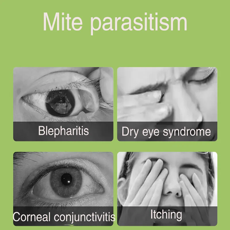 Lingettes de support de poulet apaisantes pour les yeux, élimination des acariens, huile essentielle d'arbre à thé, fête de Charleroi, fatigue oculaire