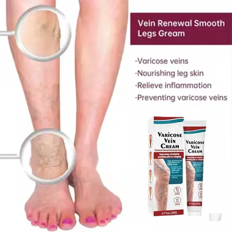 Varicose Veins Treatment Cream Vasculitis Phlebitis Spider Leg Ointment Plaster Blood Vessel Swelling Vascular Bulge Leg