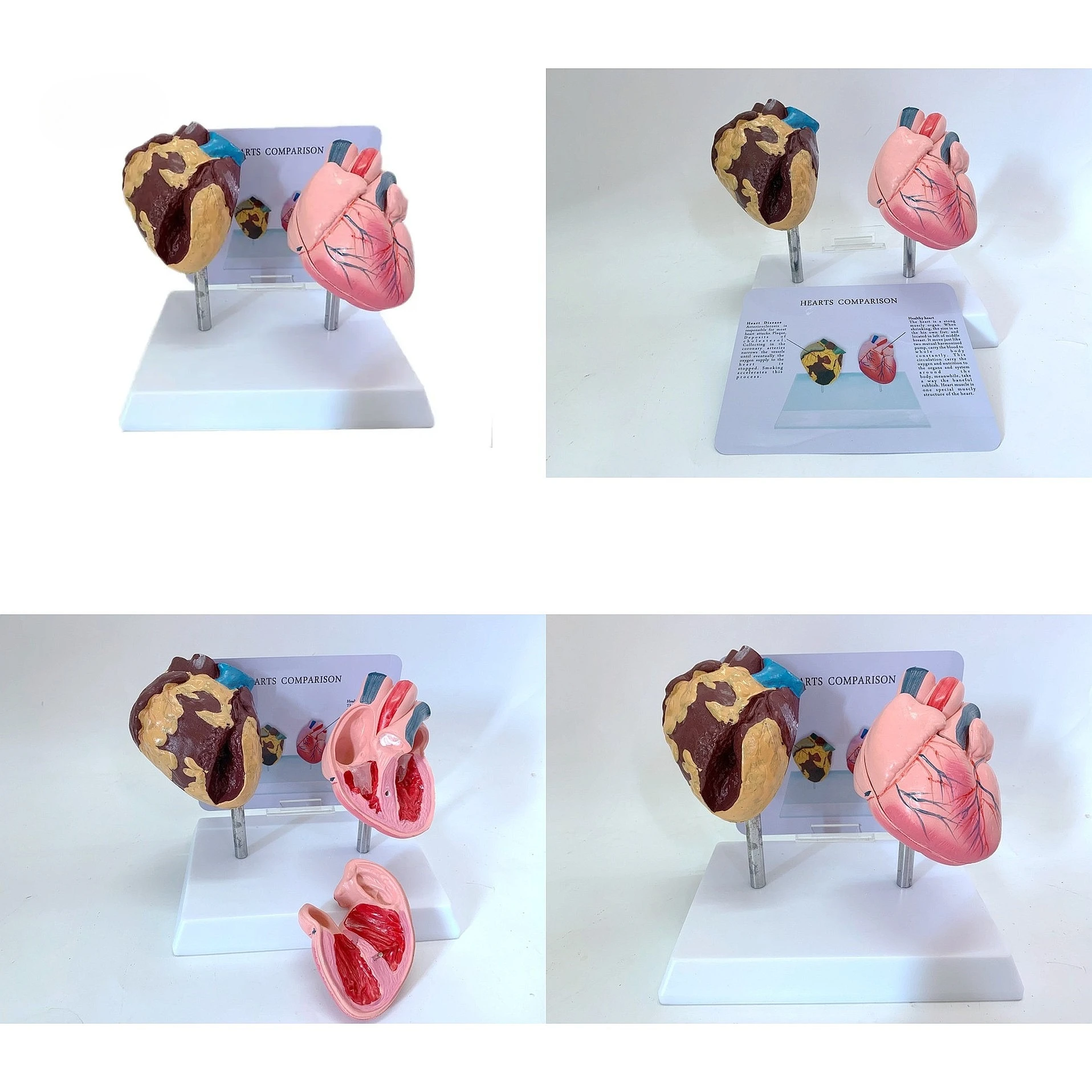 Human Organ Anatomy Model Smoker vs Healthy Heart Comparison Yulin YL2-30079