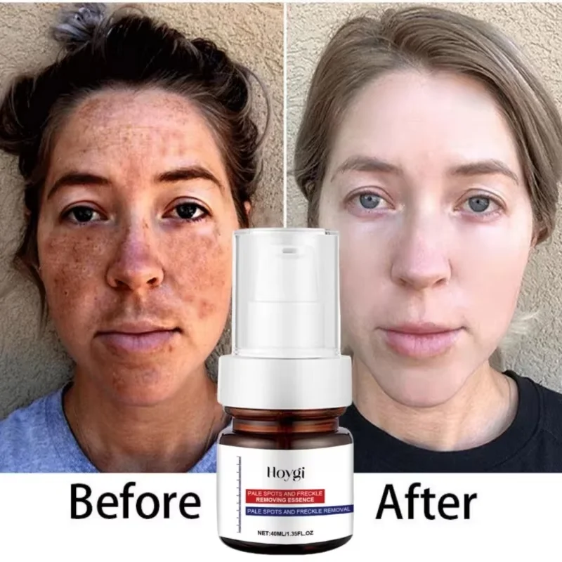 

Powerful Spot-removing Whiten Serum Cream Vitamin C Skin Brighten Serum Removal Melasma Dark Spots Moisturizing Beauty SkinCare