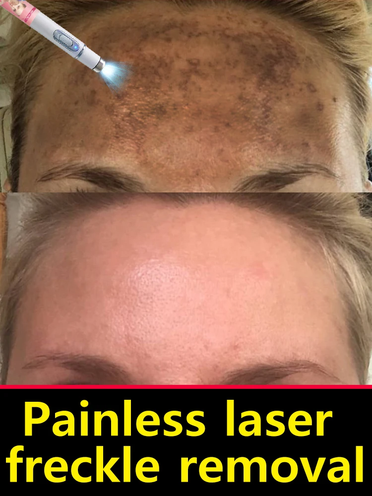 

Sársaukalaus leysimeðferð við melasma og dökkum blettum