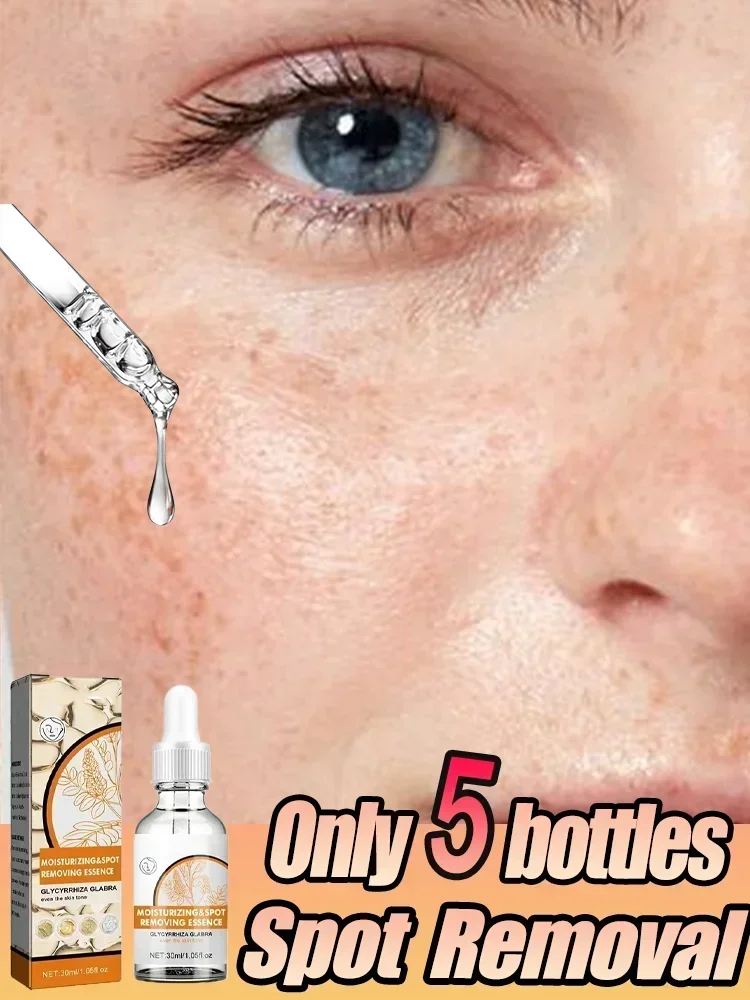 Fast Freckle Removal Serum Whitening Removes Chloasma Age Spots Hydrating Moisturizing Brightening Skin Care Facial Essence