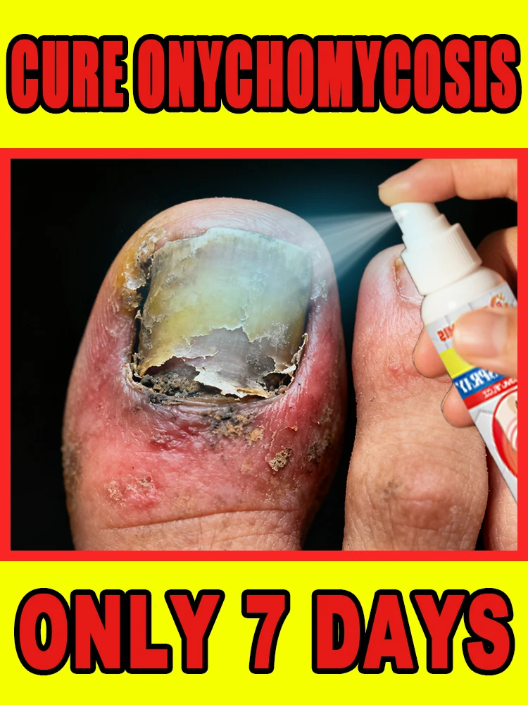

Timely treatment to avoid bacterial ⁱⁿᶠᵉᶜᵗⁱᵒⁿ ᵃⁿᵈ ᵒᵈᵒʳ ᵖʳᵒᵇˡᵉᵐˢ ᵒⁿ ᵗʰᵉ ᶠᵉᵉᵗ