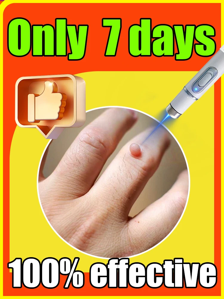 

Generation-2 Blue Light Tool, Says Goodbye To Warts In 7 Days