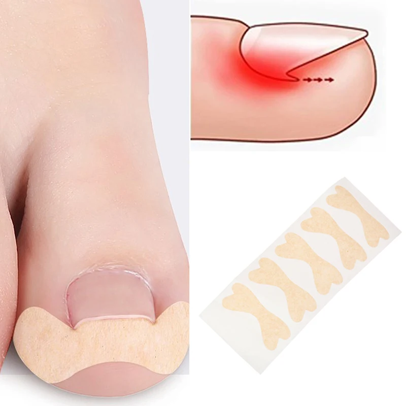 1sheet Ingrown Toe Foot Nail Correction Sticker Pedicure Toenail Corrector