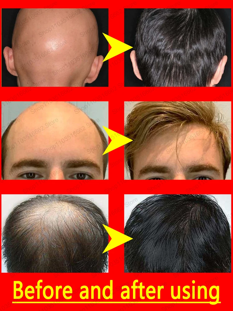 100% repair hair loss and hair follicle loss, solve hair loss and baldness