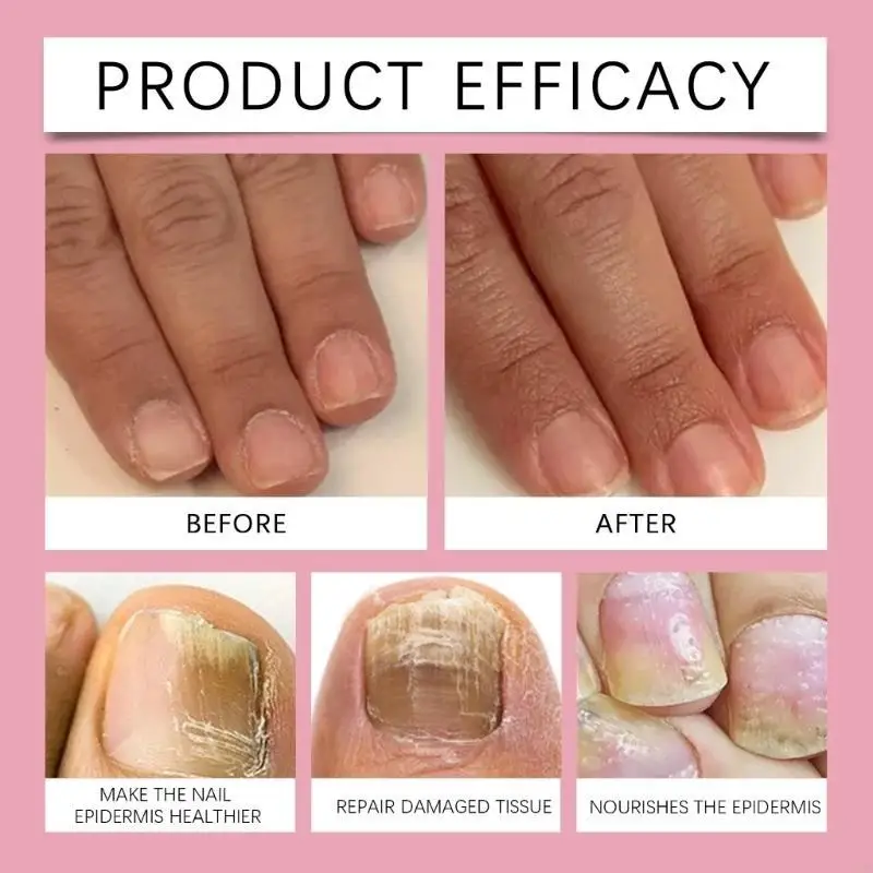 Zehennagel und Fingernägel für die Nägelwahrnehmung Flüssigkeit Mehrzwecknagelreparatur für verfärbte und beschädigte Nägel T4MB