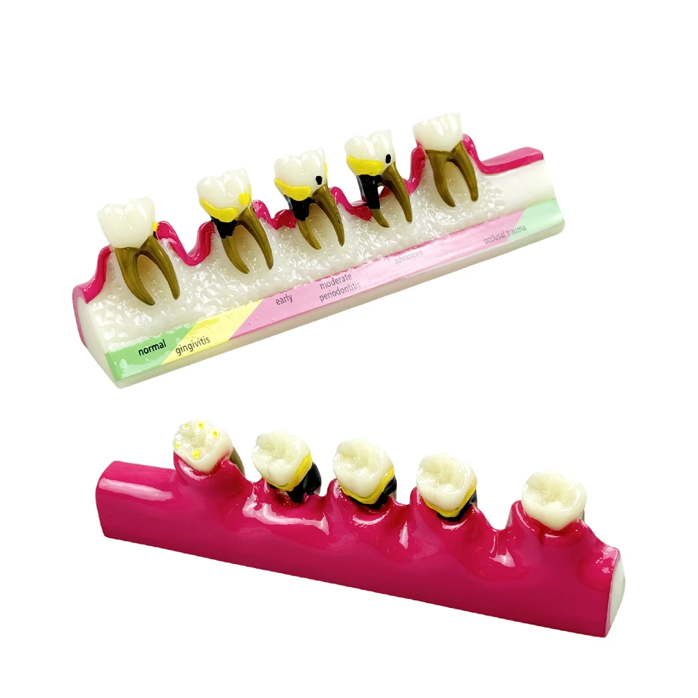 1PC Dental Periodontal Disease Model 5-Stage Perio Disease Assort Demo Typodont Caries Periodontitis Occlusal Trauma Teeth Model