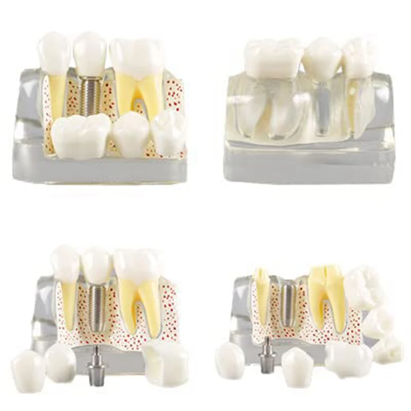 Teeth Demonstration Model Implant Removable Analysis Crown Bridge For -Patient Communication