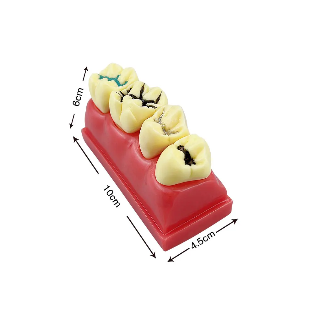 Dental Study Model 4 Times Pit And Fissure Sealing Treatment Teeth Model Dentist Demonstration Model Dentistry Tool Laboratory