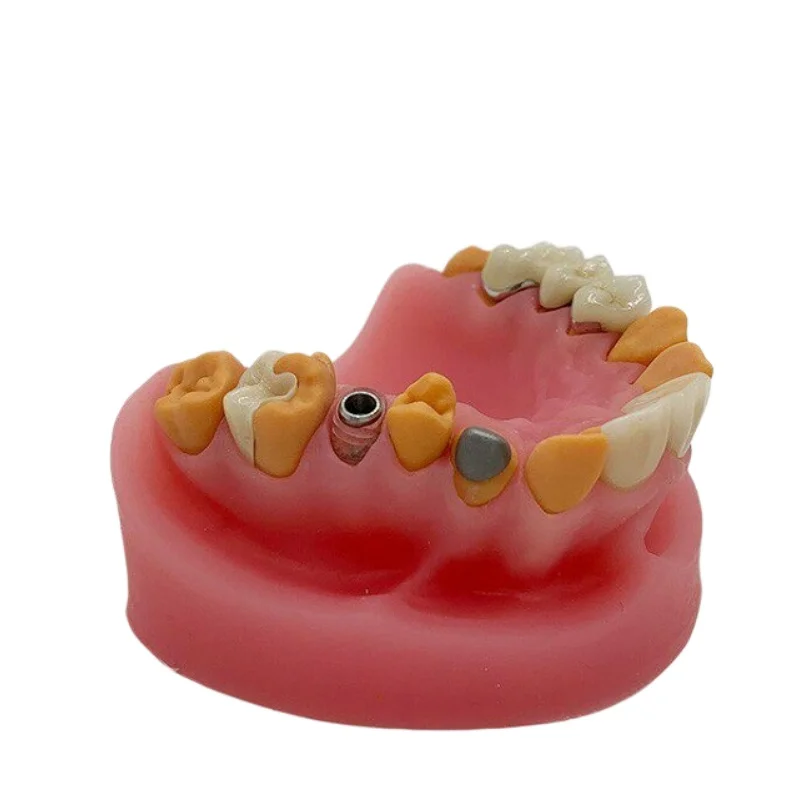 

1PC Silicone Dental Restoration Mold Display Inlay Veneer Porcelain Bridge Dental Implant Abutment Model for Dental Lab Training