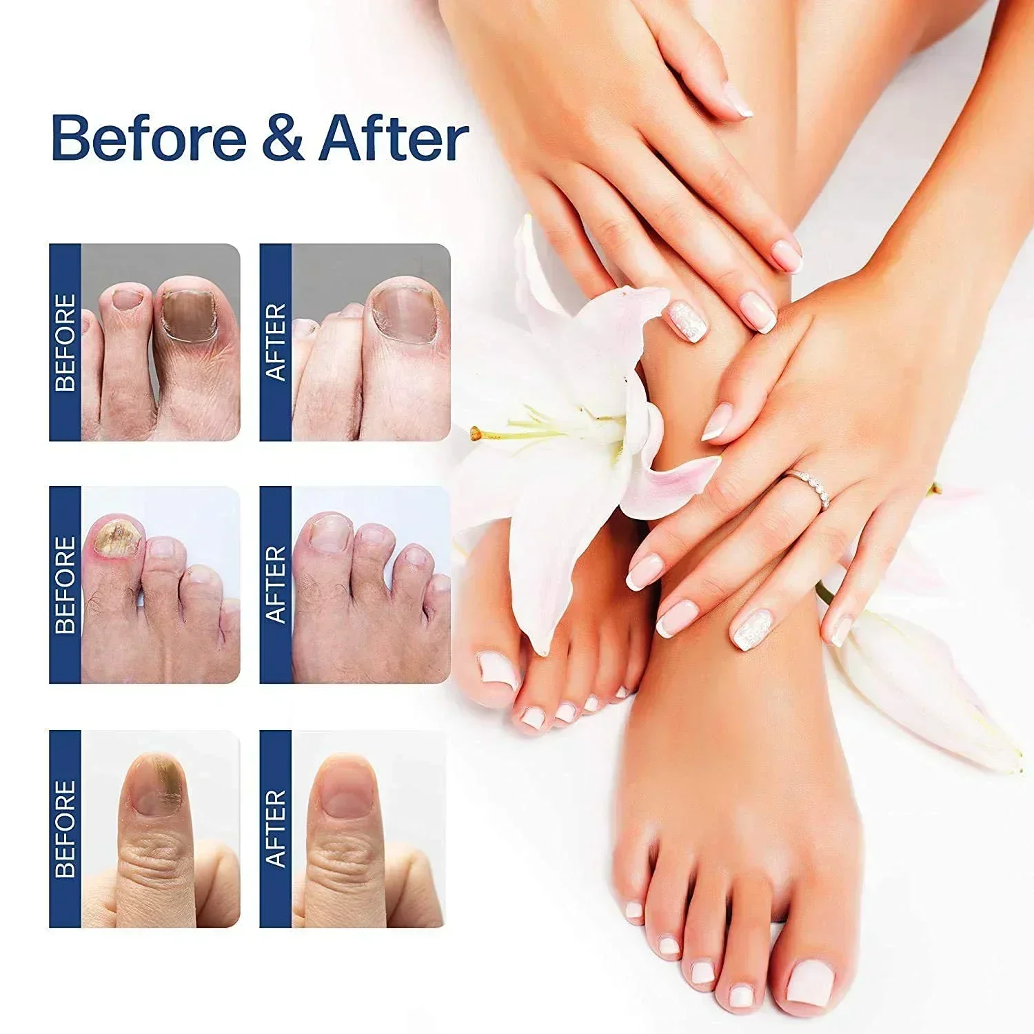 Nail Fungus Tratamento Soro, Toe Fungal Repair Products, Hand Foot Care, Gel de remoção, Anti infecção, Onicomicose, Paroníquia