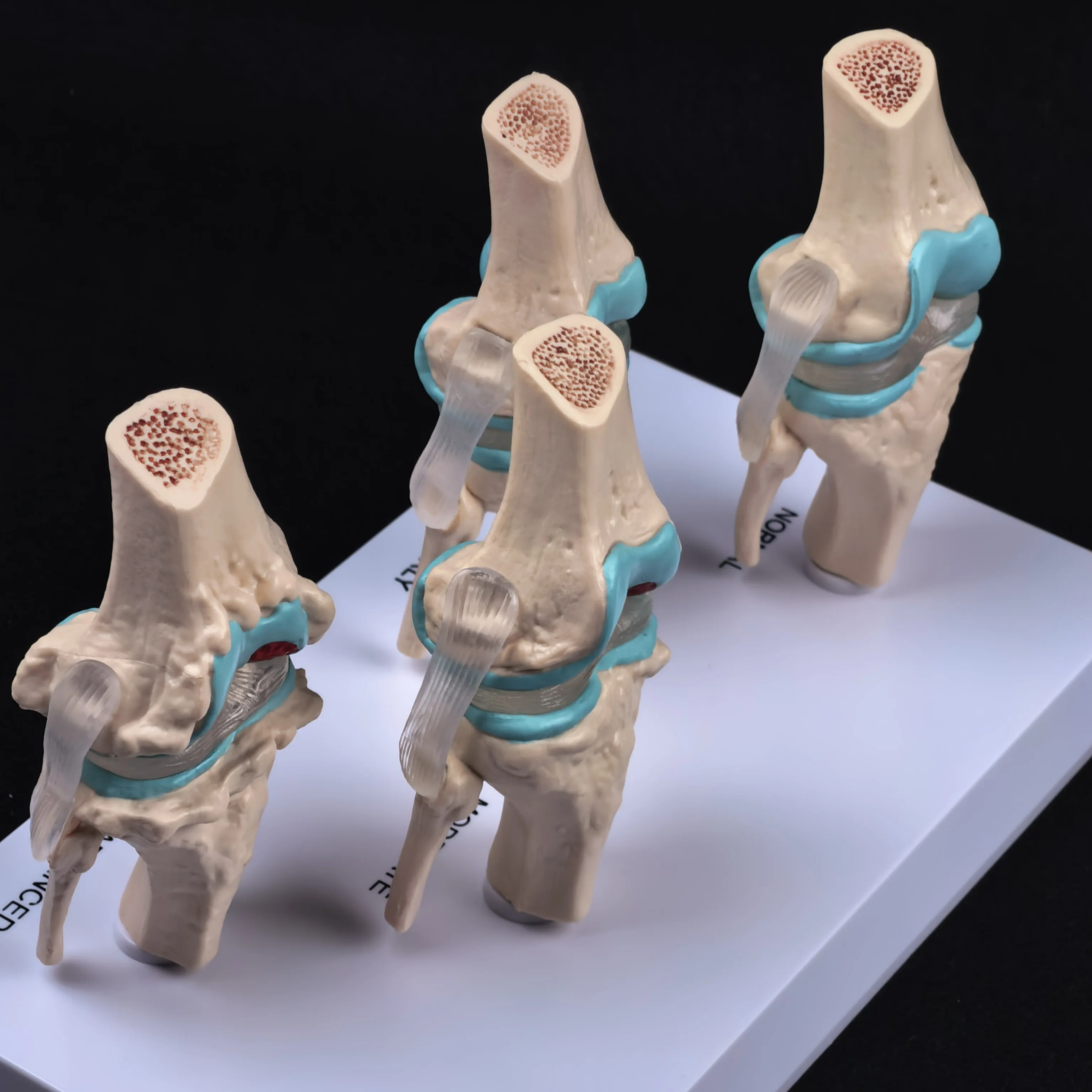 نموذج مرض مفصل الركبة التشريحي البشري المزخرف تشريح الهيكل العظمي الطبي موارد التدريس PVC #1