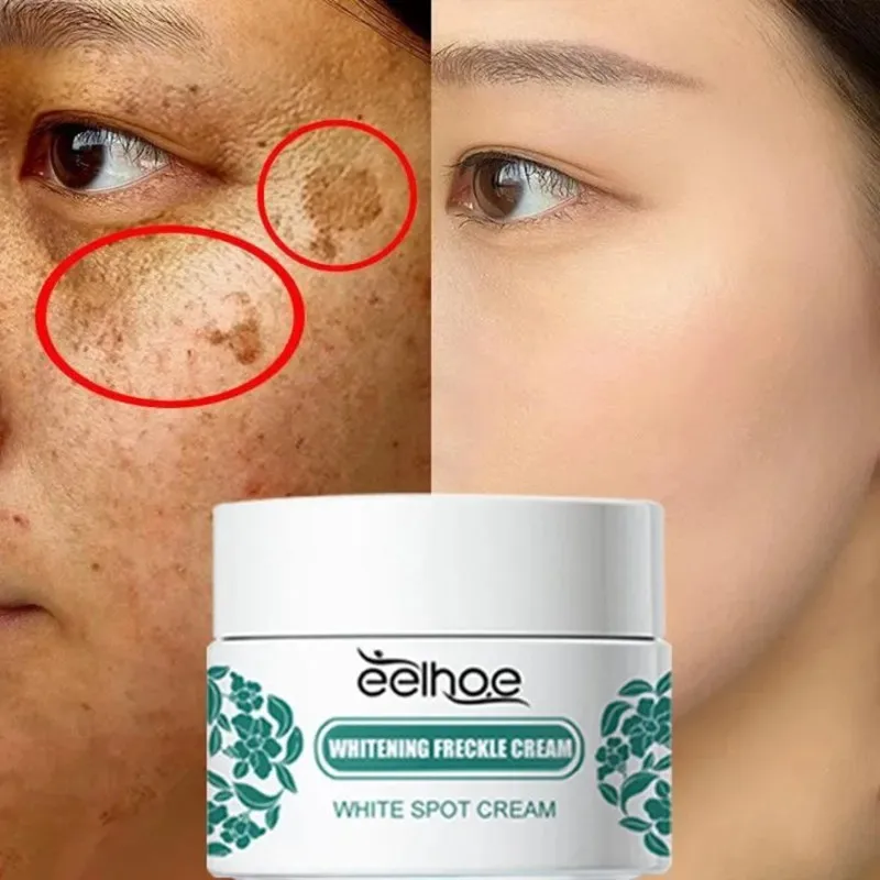 Niacinamida Melasma Brightening Cream, Reduzir Melanina Iluminar, Clarear a pele escura, Soro de Chloasma, Fade Fine Lines, Face Care