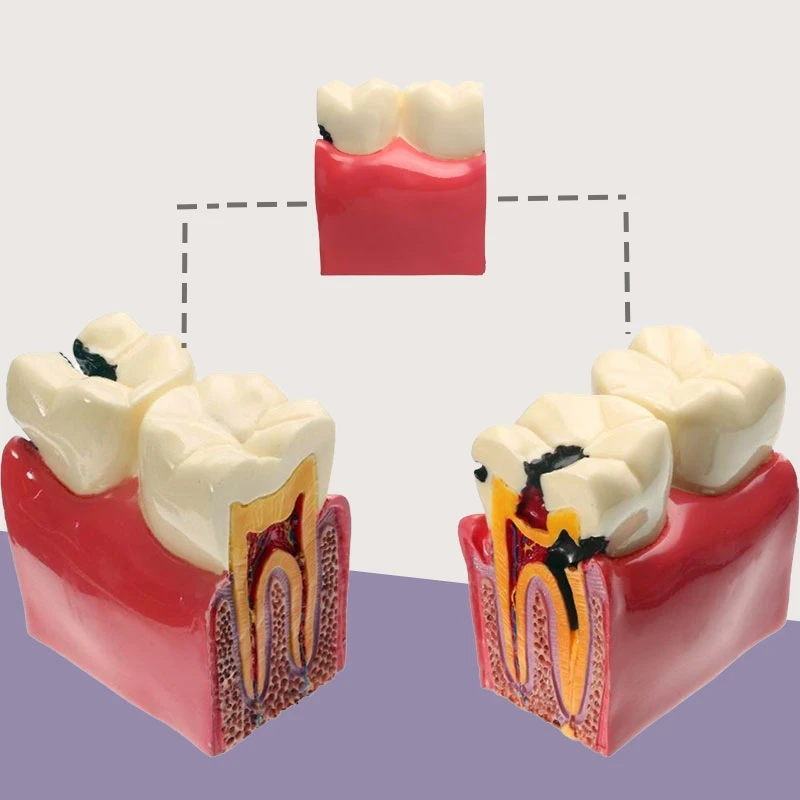 

1Pcs Dental Models 6 Times Caries Comparation Decomposition Dentistry Lab Teaching Student Studying Typodont Teeth Model