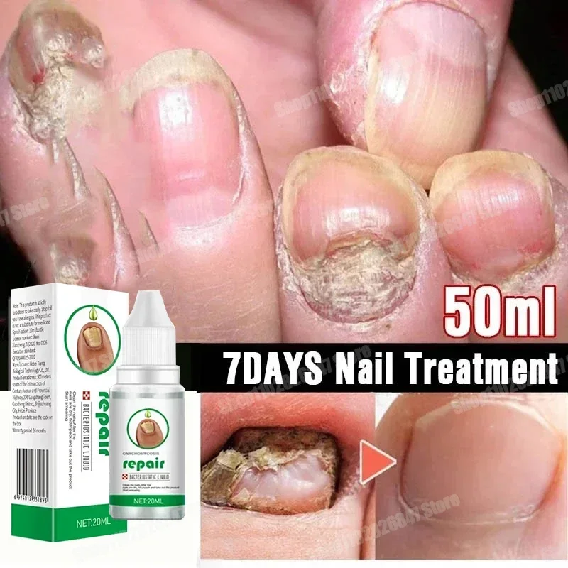 เชื้อราเล็บ Renewal Nail Repair Liquid สําหรับเปลี่ยนสีหนา Crumbled Nails เชื้อราเล็บสําหรับเปลี่ยนสีหักแตก 77