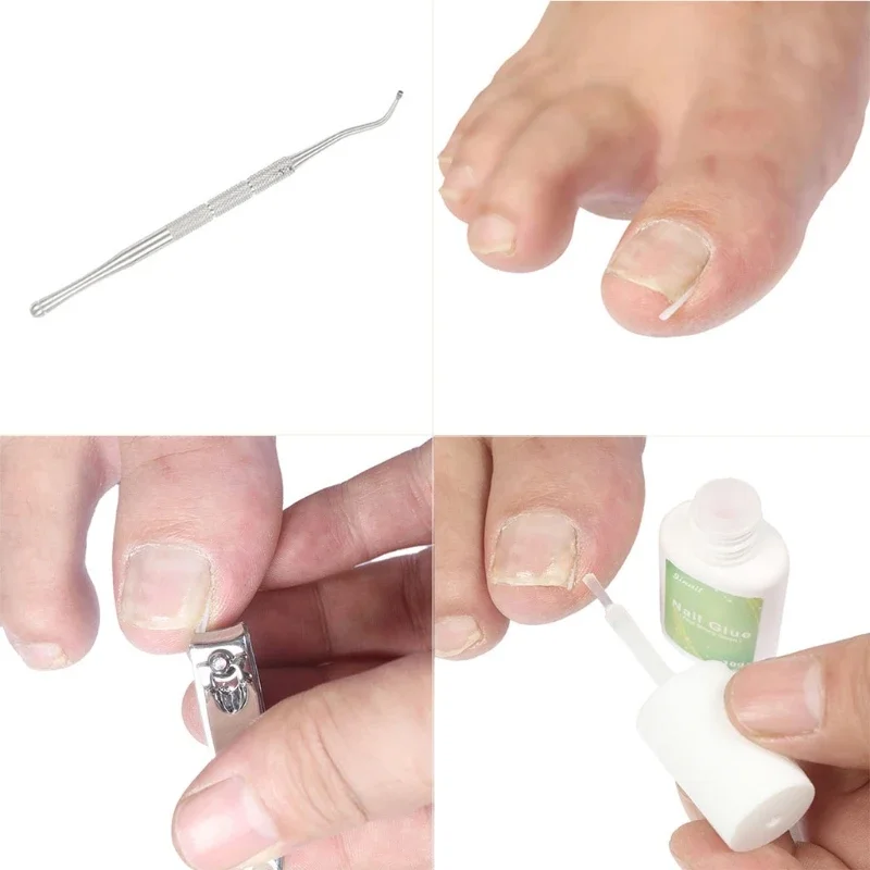 Outil correction des ongles incarnés, soins douleur, correcteur d'ongles incarnés, utilisé pour maison, 10