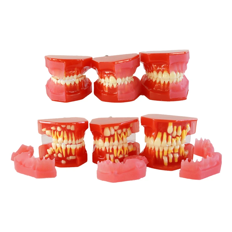 

Dental Materials Standard Dental Teaching Model Study Orthodontic Model Dentition Development Model Caries Model of Child