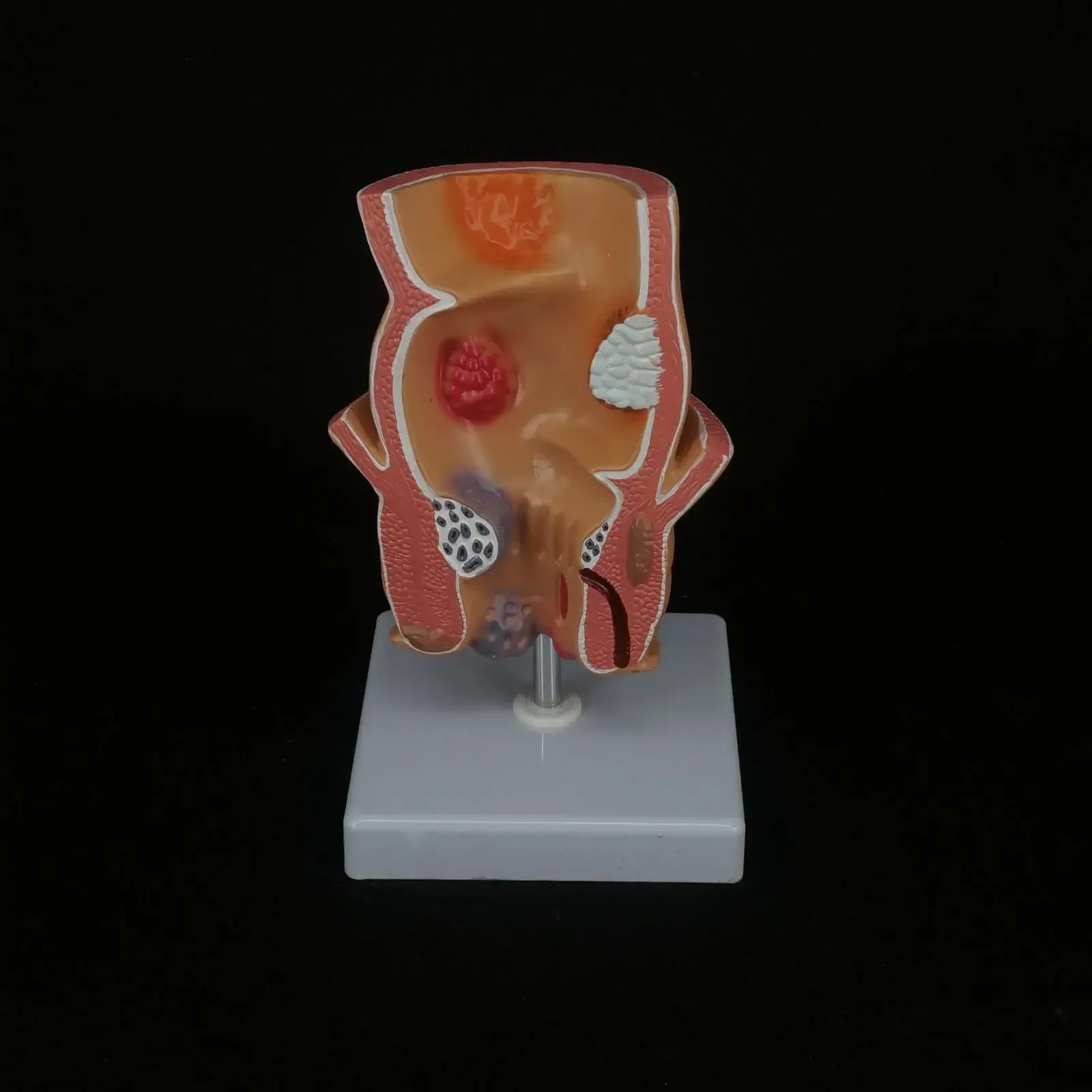 PVC Anatomical Human Rectum Pathology Lesion Model Hemorrhoids Anus Medical Teaching Rectal Learning