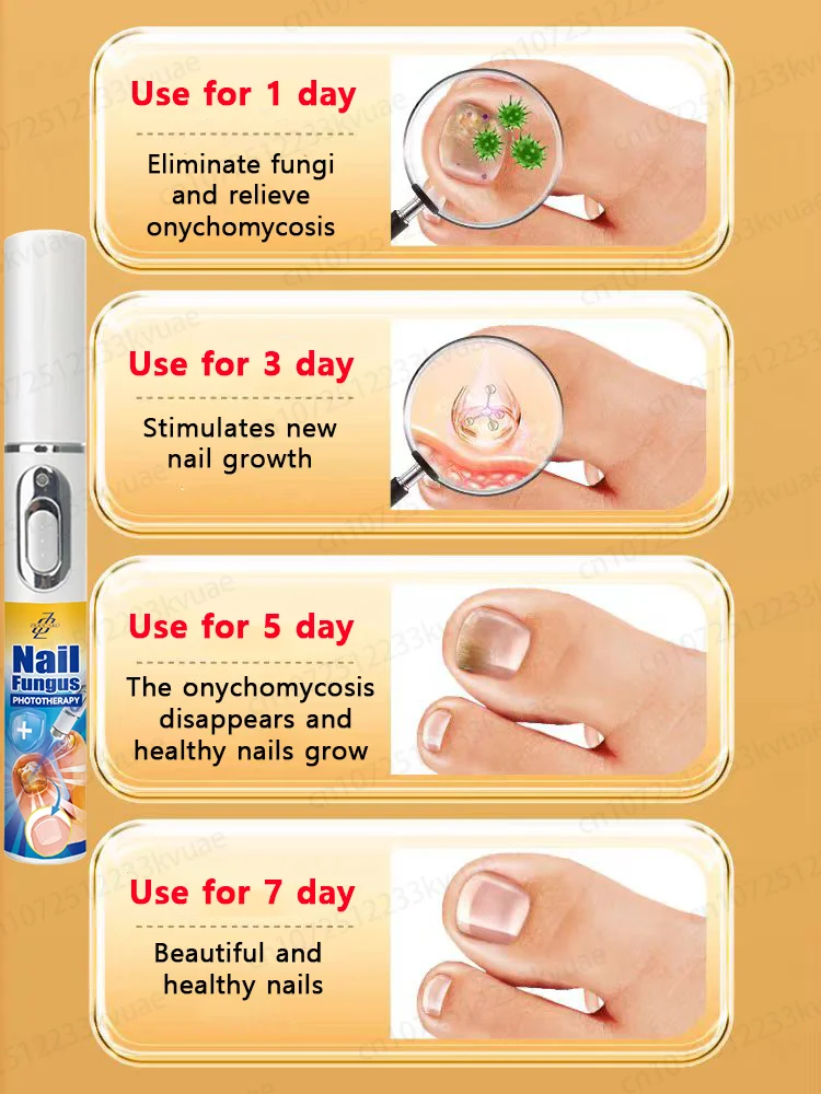 

Laser repair to say goodbye to onychomycosis