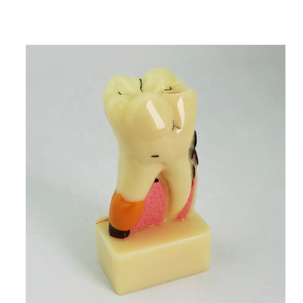 

4 Times Caries Demonstration Model Tooth Model