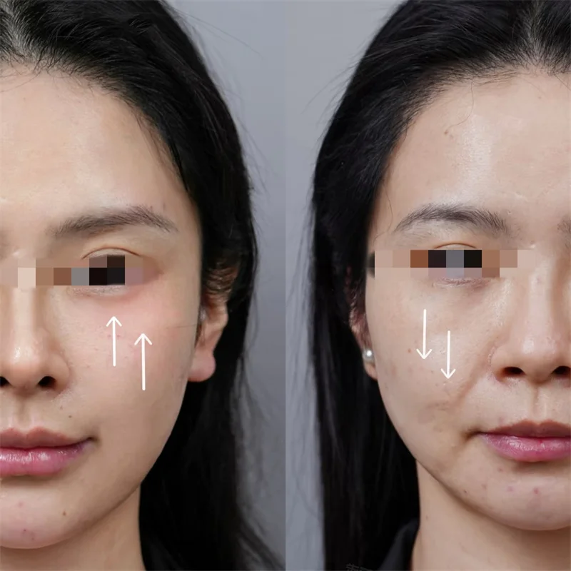 Tragbares Facelifting-Körpermassagegerät, Radiofrequenz, Mikrostrom, goldener Finger, RF, Ems, Schönheitsmaschine, Diamantfinger