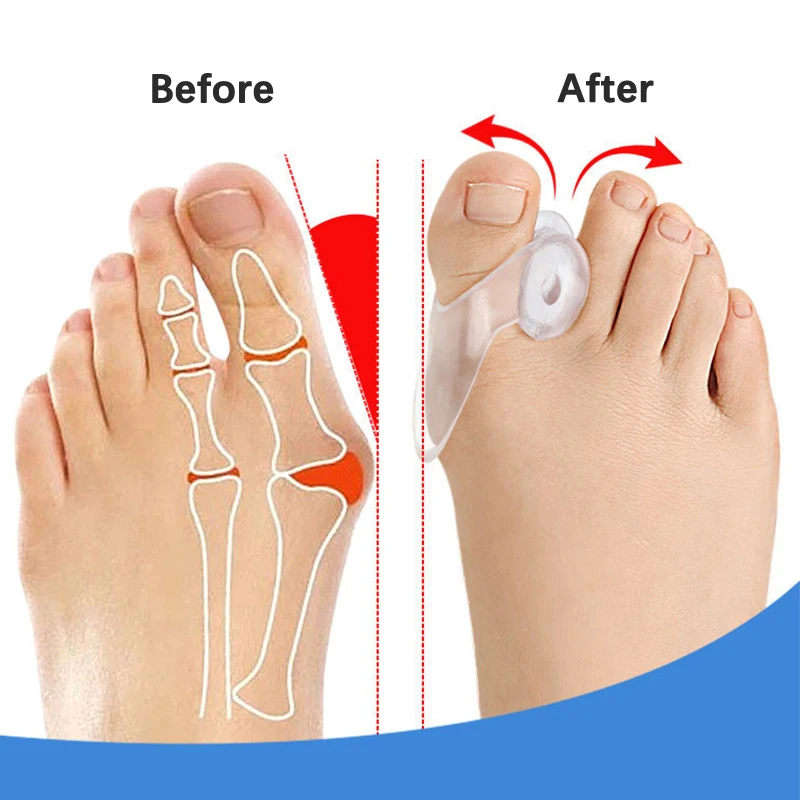 2Pcs Silicone Gel Thumb Corrector Bunion Foot Toe Hallux Valgus Protector Separator Finger Straightener Adjuster Foot Care Tool