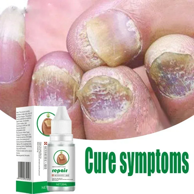 Fungal Nail Treatment Oil Foot Repair Essence Toe Nail Fungus Removal Gel Anti Infection Cream Fungal Nail Removal Paronychia