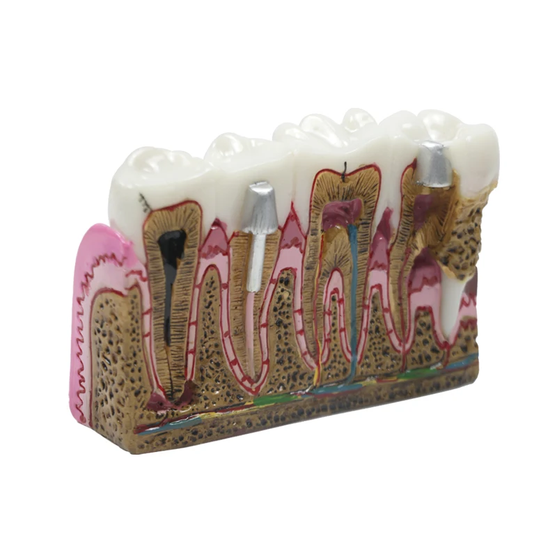 Dental Caries Anatomy Model Comprehensive Pathology Tooth Nerve Tooth Model for Oral Teaching Teeth Model Dental Materials