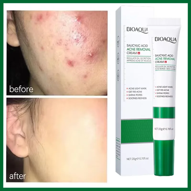 

Salicylic Acid Acne Removal Cream Anti-Acne Repair Redness Pimple Spots Deep Cleaning Pore Oil Control Smoothing FaceSkin Care