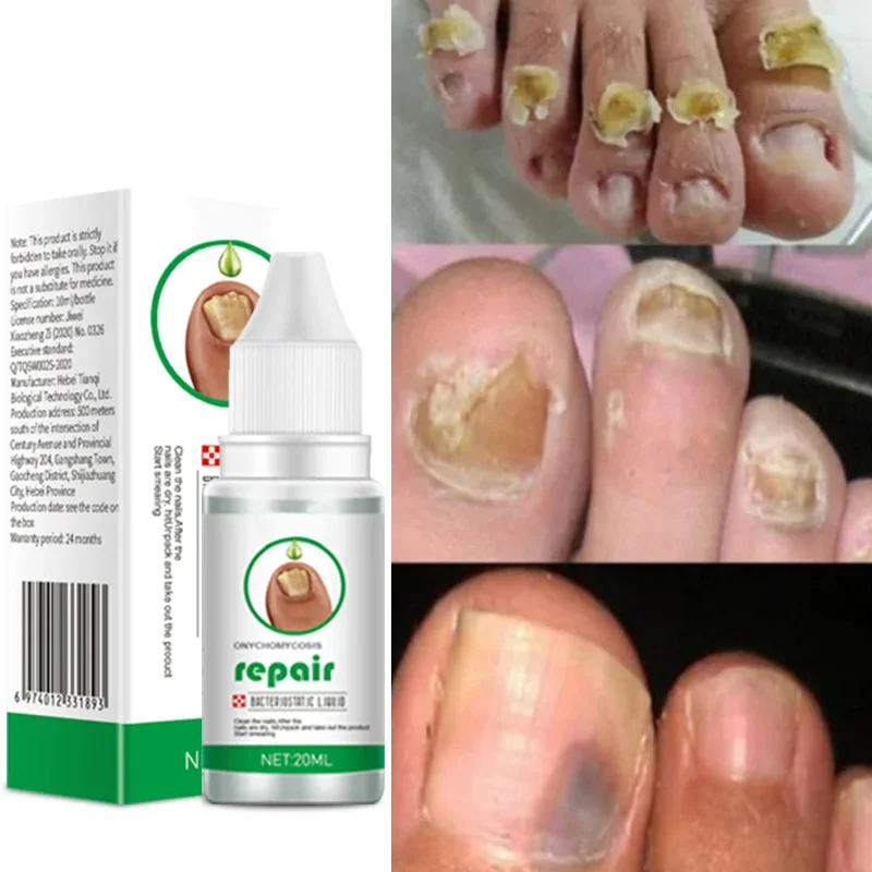 Laser irradiation nail fungus nail repair solution is used for discolored, thickened and fragmented nails. Laser irradiation pen