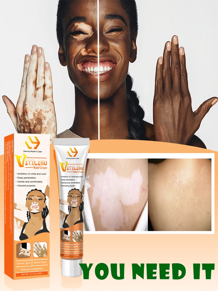 

Vitiligo Cream