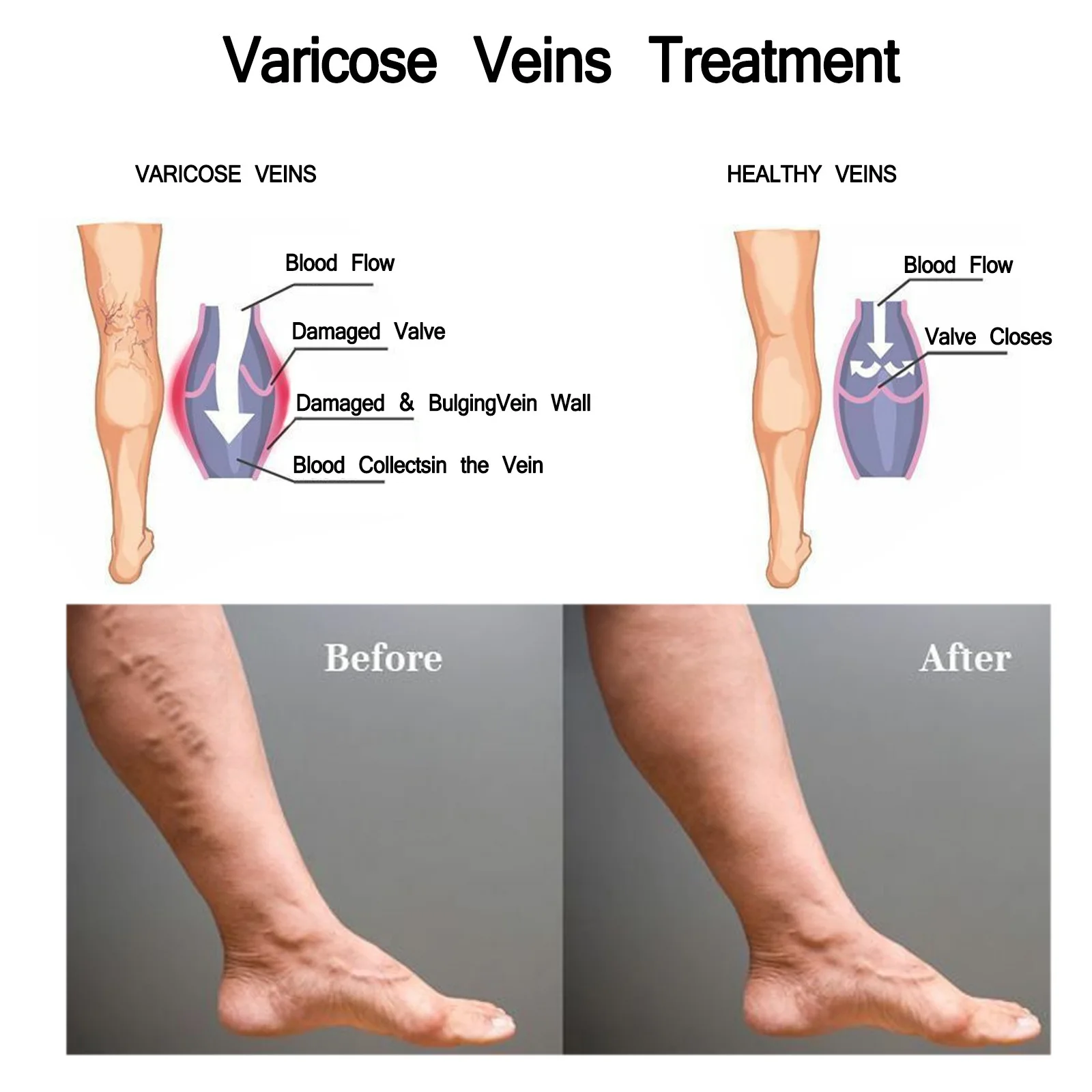 Varicose Vein Patch Circulation Paste for Legs Soothing Leg Treat Improves The Appearance of Varicose Vein Personal Health Care