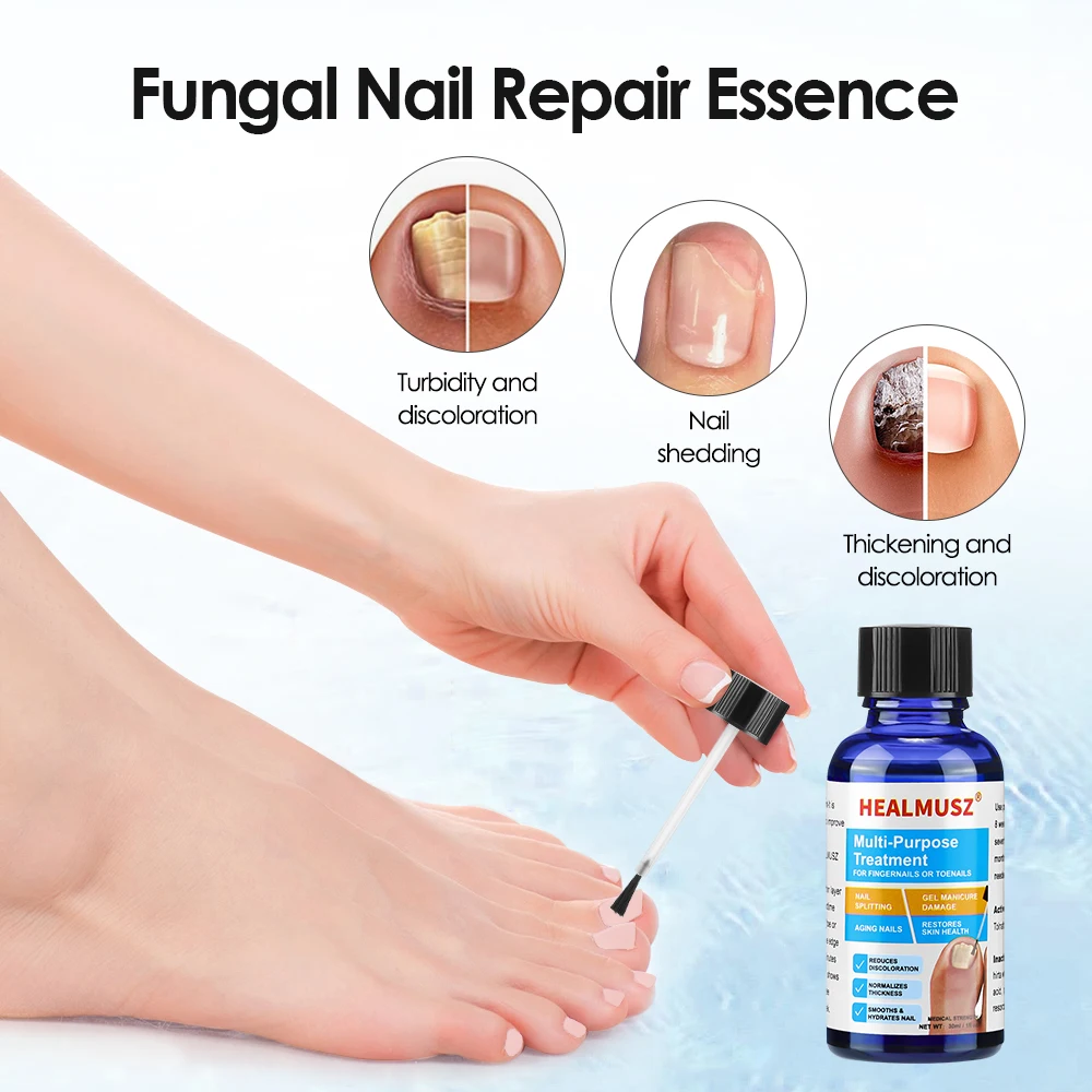30ml เท้าเล็บเชื้อรา Treatment Toenail Repair Essence Serum Liquid ฟุต Toes Care เครื่องมือเชื้อรา Removal