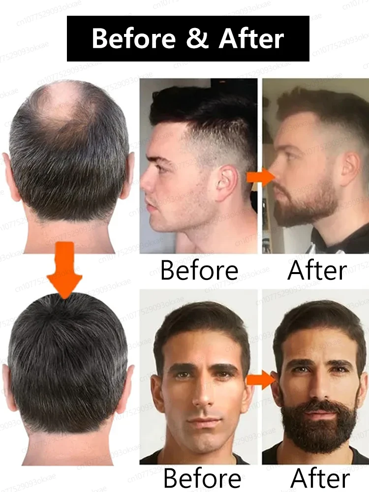 The most effective beard growth essence in 2025, grow a thick beard in 7 days. Chest hair, leg hair, beard and hair growth