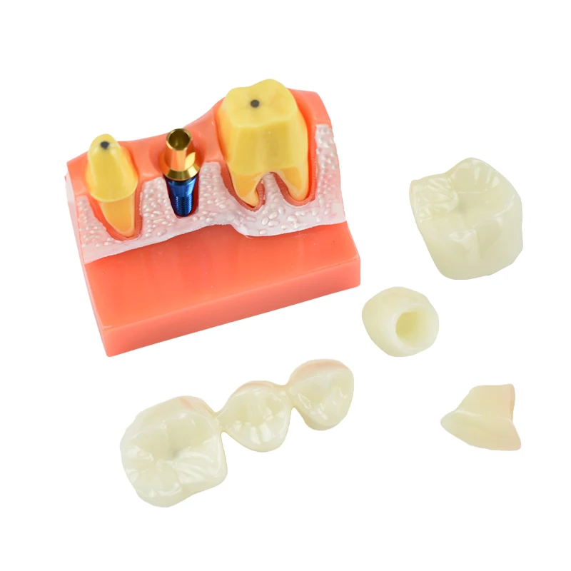 

Dental Implant Teeth Model 4 Times False Teeth Analysis Crown Bridge Removable Model Dentist Demonstration Tool