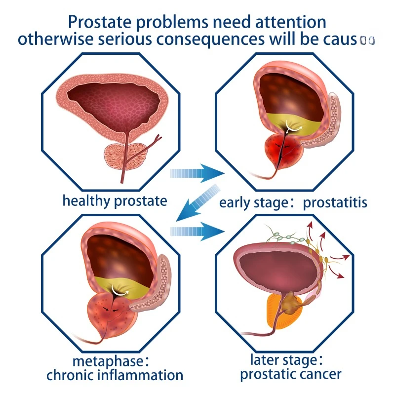 Patch para o umbigo da próstata para homens, Tratamento de prostatite Medicina de gesso, Urologia Prostatic Acupoint Sticker, Cuidados de saúde