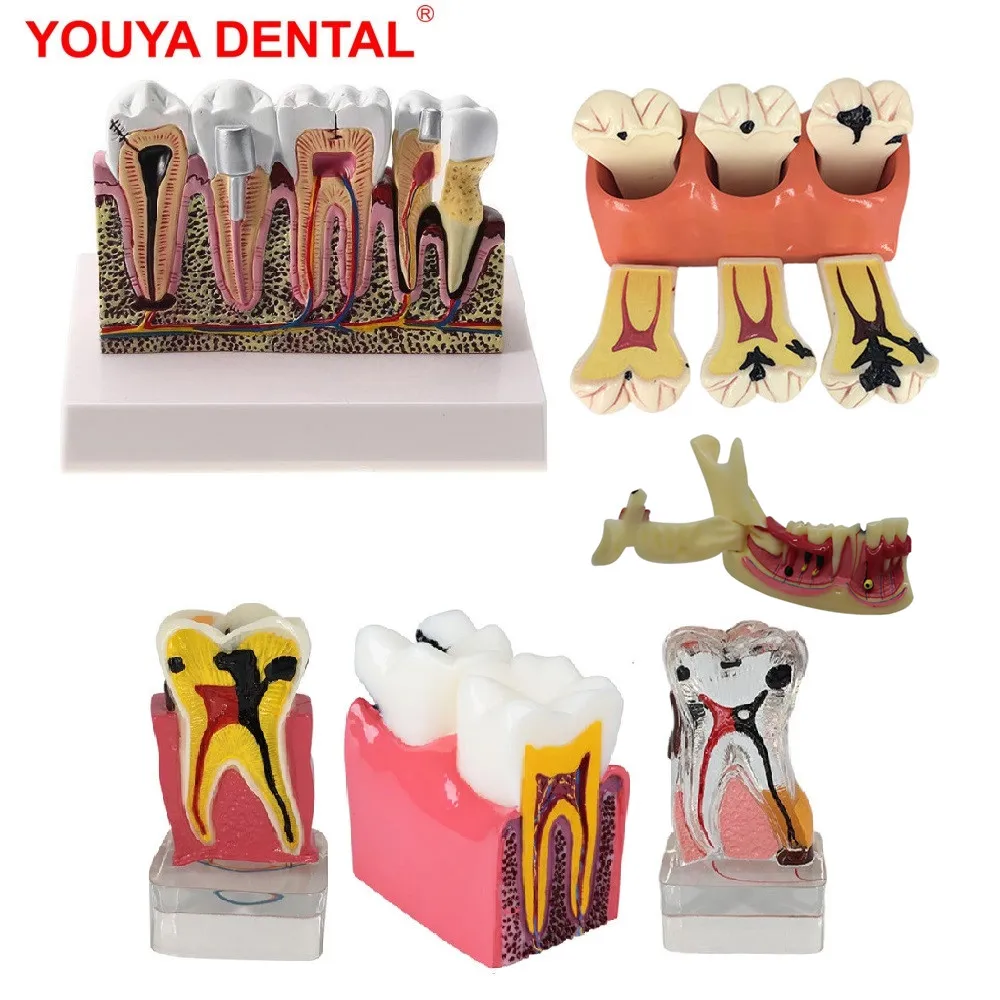 Teeth Anatomy Dental Model Teaching Study Dental Anatomical Model for Dentist Patient Education Demonstration Dentistry Products